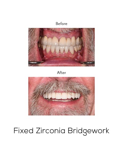 Fixed Implant Bridgework Before & After Gallery - Patient 593040 - Image 1