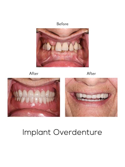 Implant Retained Overdentures Before & After Gallery - Patient 131358 - Image 1