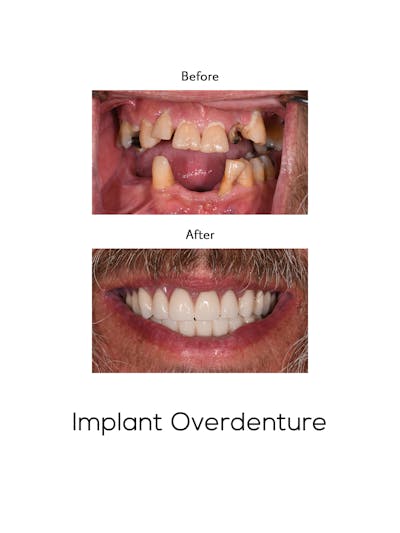 Implant Retained Overdentures Before & After Gallery - Patient 107200 - Image 1