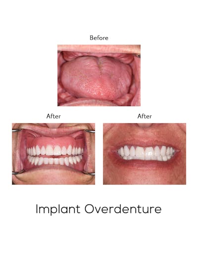 Implant Retained Overdentures Before & After Gallery - Patient 417437 - Image 1