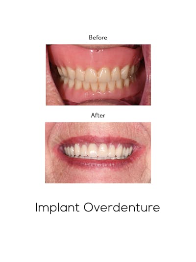 Implant Retained Overdentures Before & After Gallery - Patient 356606 - Image 1