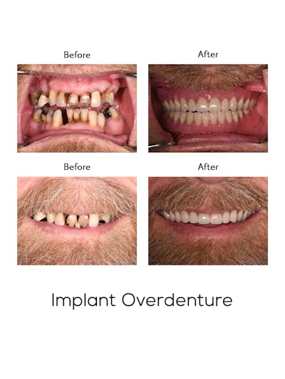 Implant Retained Overdentures Before & After Gallery - Patient 977275 - Image 1
