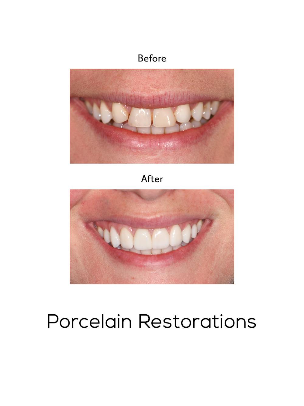 Restorations on Natural Teeth Before & After Gallery - Patient 390557 - Image 1