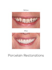 Restorations on Natural Teeth Before & After Gallery - Patient 390557 - Image 1