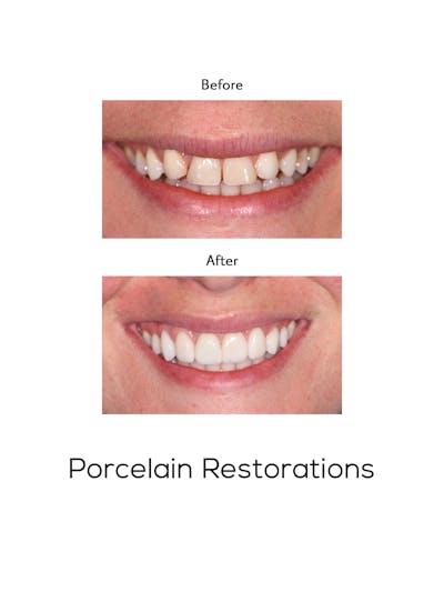 Restorations on Natural Teeth Before & After Gallery - Patient 390557 - Image 1