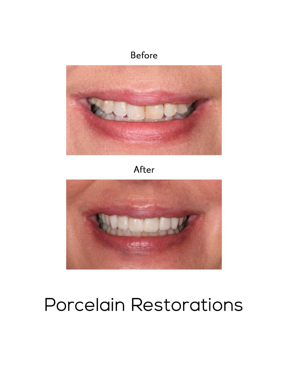 Restorations on Natural Teeth Before & After Gallery - Patient 393331 - Image 1