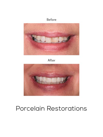 Restorations on Natural Teeth Before & After Gallery - Patient 393331 - Image 1