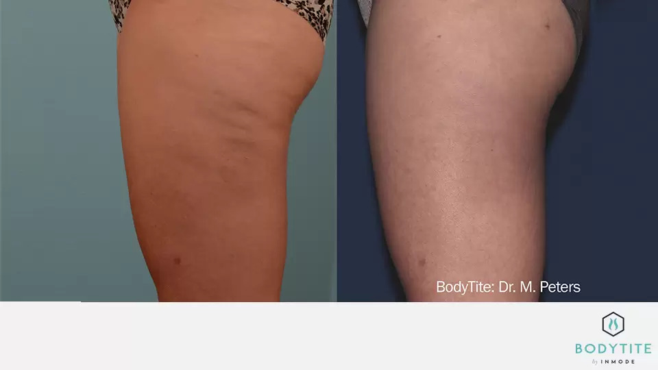 BodyTite before and after photo #8