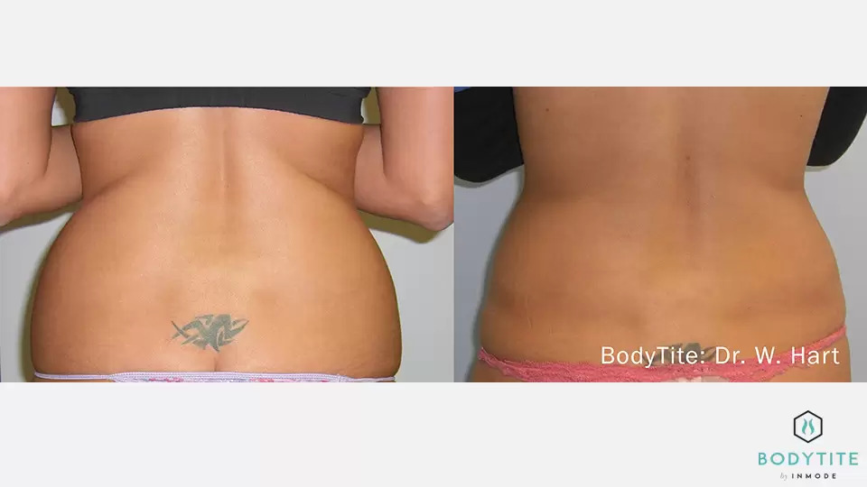 BodyTite before and after photo #10