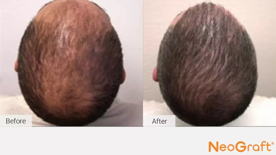 Hair Restoration Kirkland | NeoGraft Auburn, WA Hair Restoration Kirkland | NeoGraft Auburn, WA
