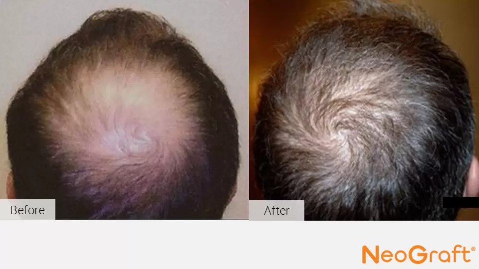 Hair Restoration Kirkland | NeoGraft Auburn, WA Hair Restoration Kirkland | NeoGraft Auburn, WA