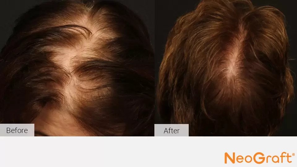 Hair Restoration Kirkland | NeoGraft Auburn, WA Hair Restoration Kirkland | NeoGraft Auburn, WA