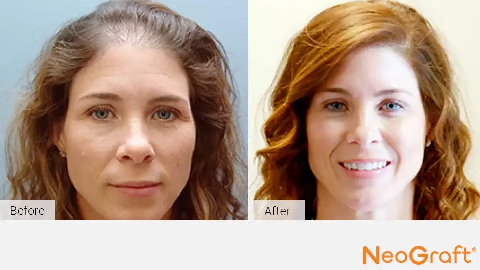 Hair Restoration Kirkland | NeoGraft Auburn, WA