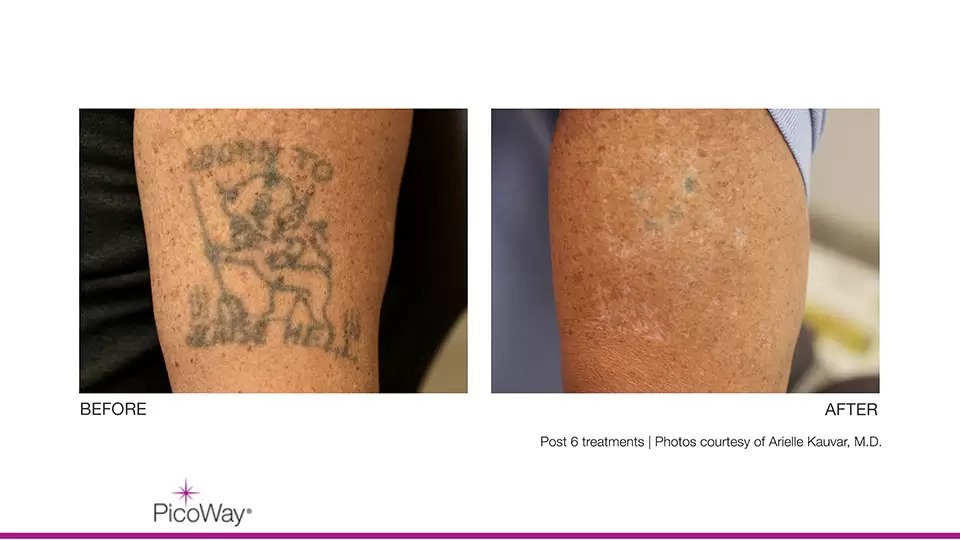 PicoWay Tattoo Removal  YouTube
