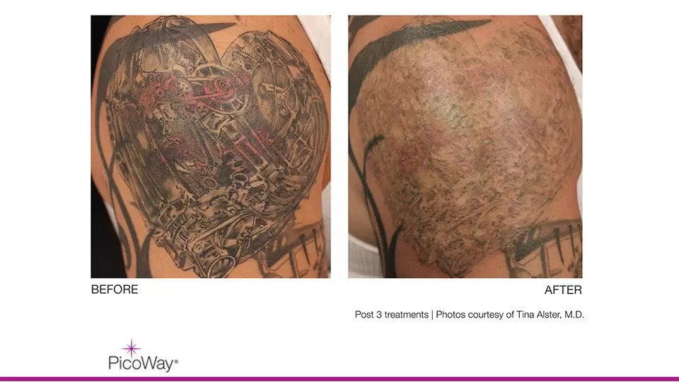 PicoWay Tattoo Removal  Dr D Neal Mastruserio MD LLC