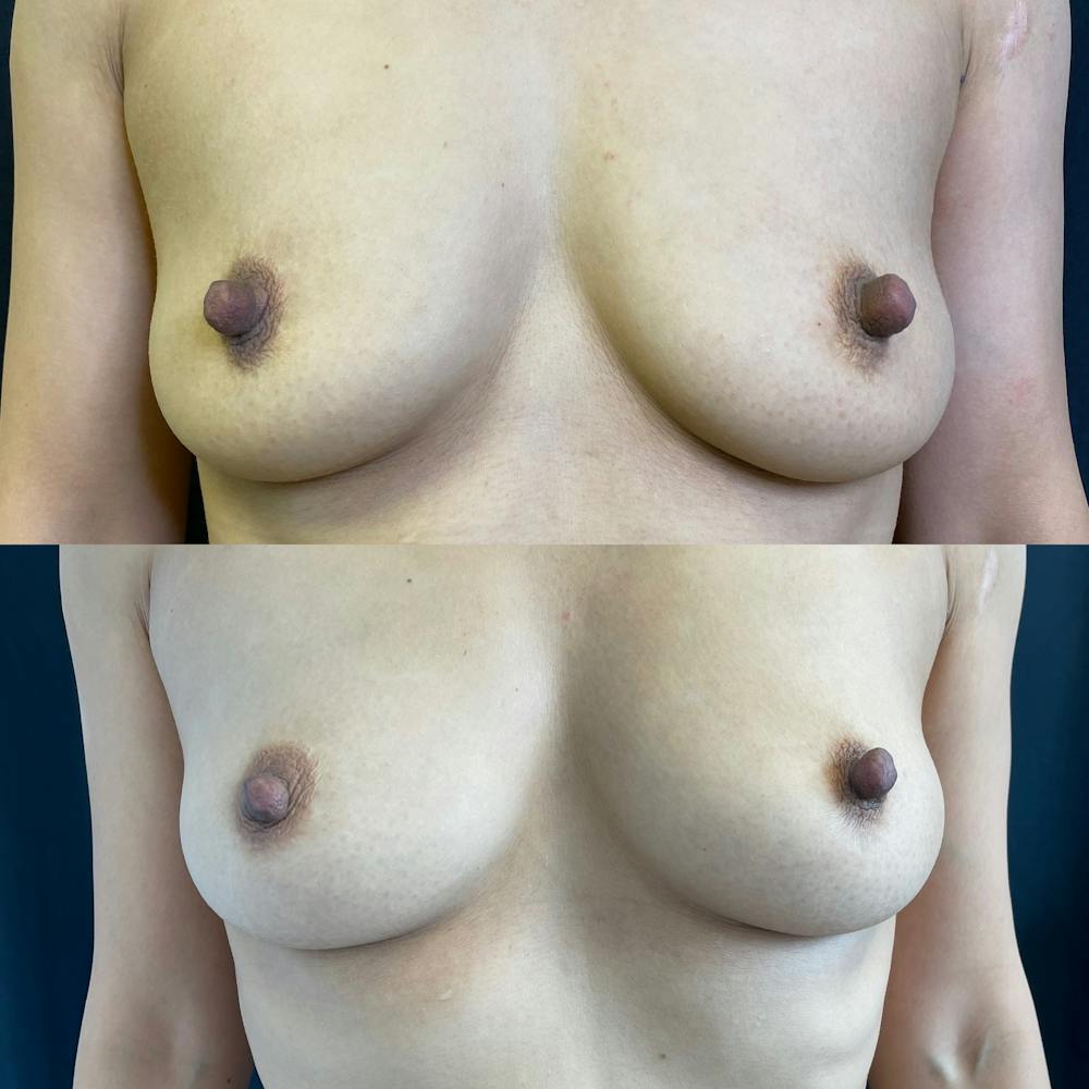 Fat Transfer Breast Augmentation Before & After Gallery - Patient 42746054 - Image 1