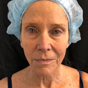 Facelift B&A