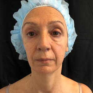 Facial Fat Transfer