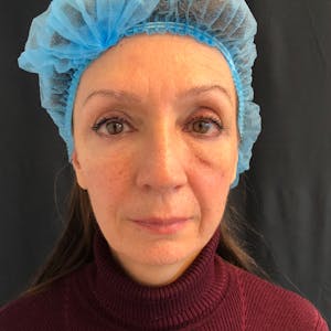 Facial Fat Transfer