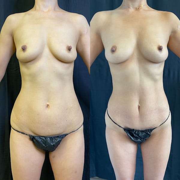 Tummy Tuck (Abdominoplasty)  Before & After Gallery - Patient 42746306 - Image 1