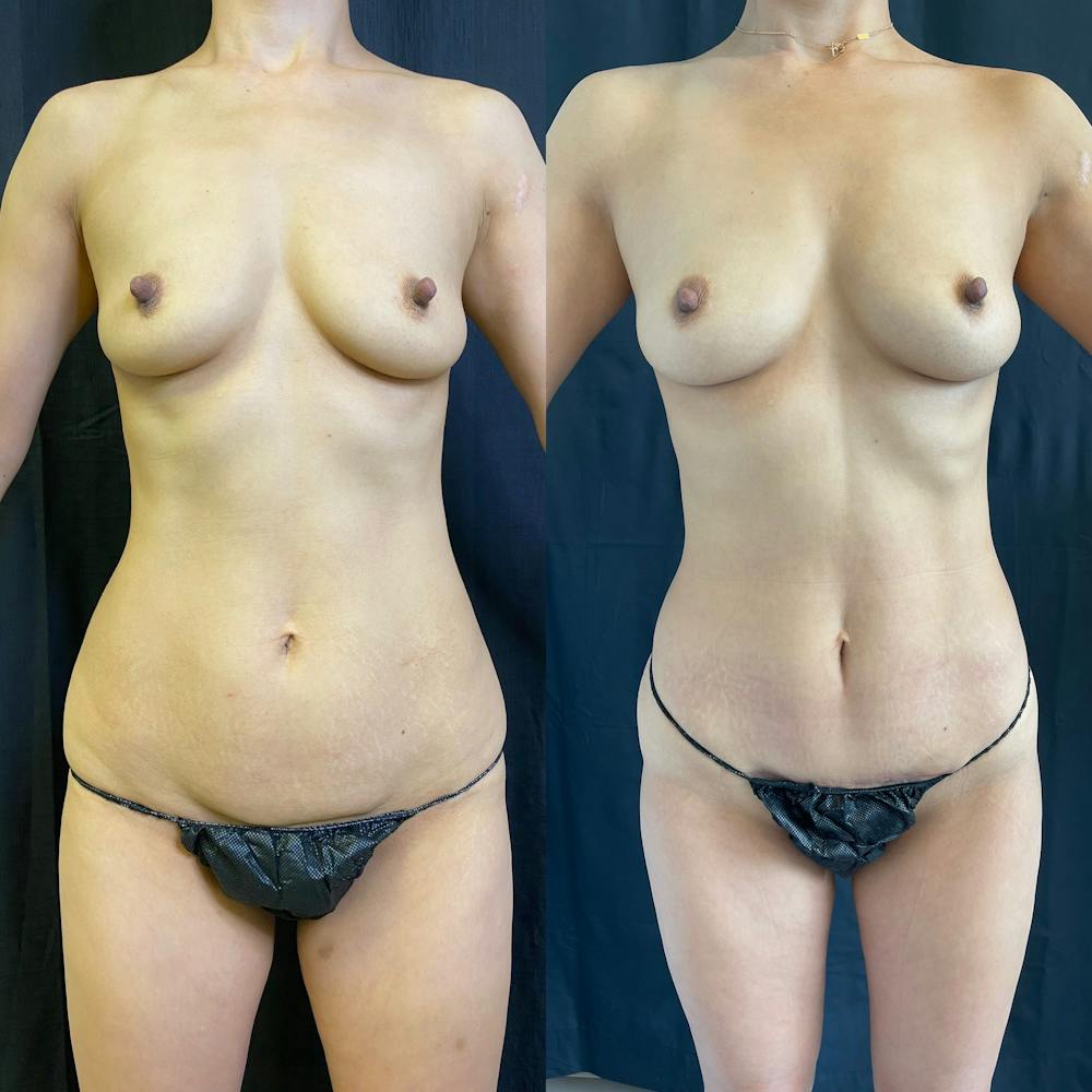 Mommy Makeover Before & After Gallery - Patient 42746312 - Image 1