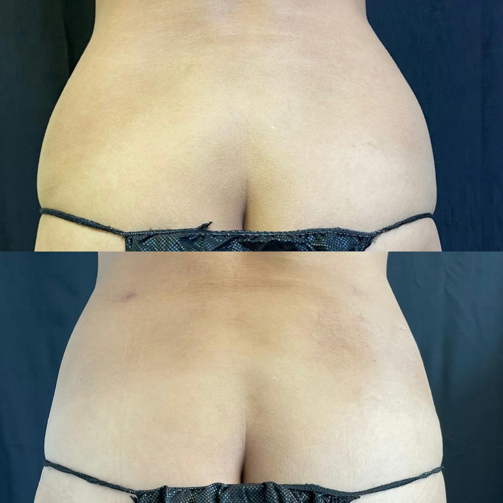 Mommy Makeover Before & After Gallery - Patient 42746312 - Image 3