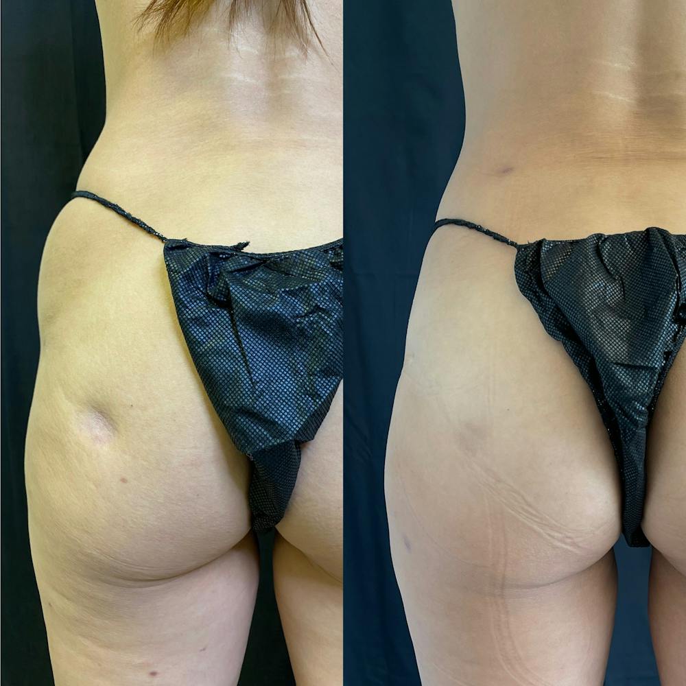 Mommy Makeover Before & After Gallery - Patient 42746312 - Image 4