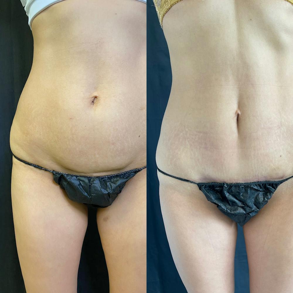 Mommy Makeover Before & After Gallery - Patient 42746312 - Image 6