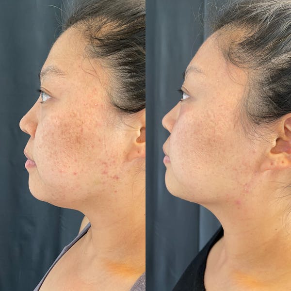 LaseMD Before & After Gallery - Patient 42746346 - Image 1