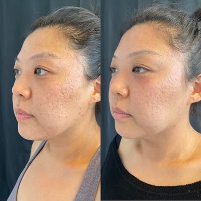 LaseMD Before & After Gallery - Patient 42746346 - Image 2