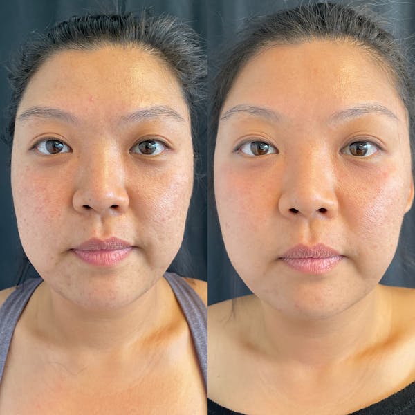 LaseMD Before & After Gallery - Patient 42746346 - Image 3