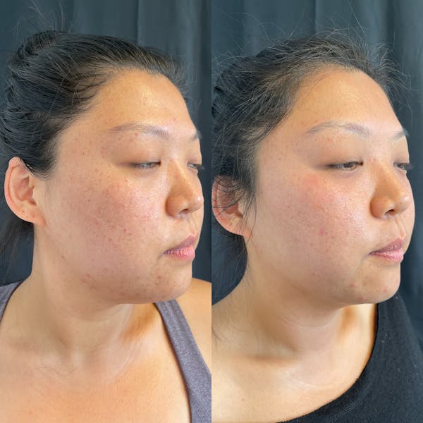 LaseMD Before & After Gallery - Patient 42746346 - Image 4