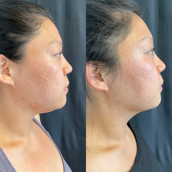 LaseMD Before & After Gallery - Patient 42746346 - Image 5
