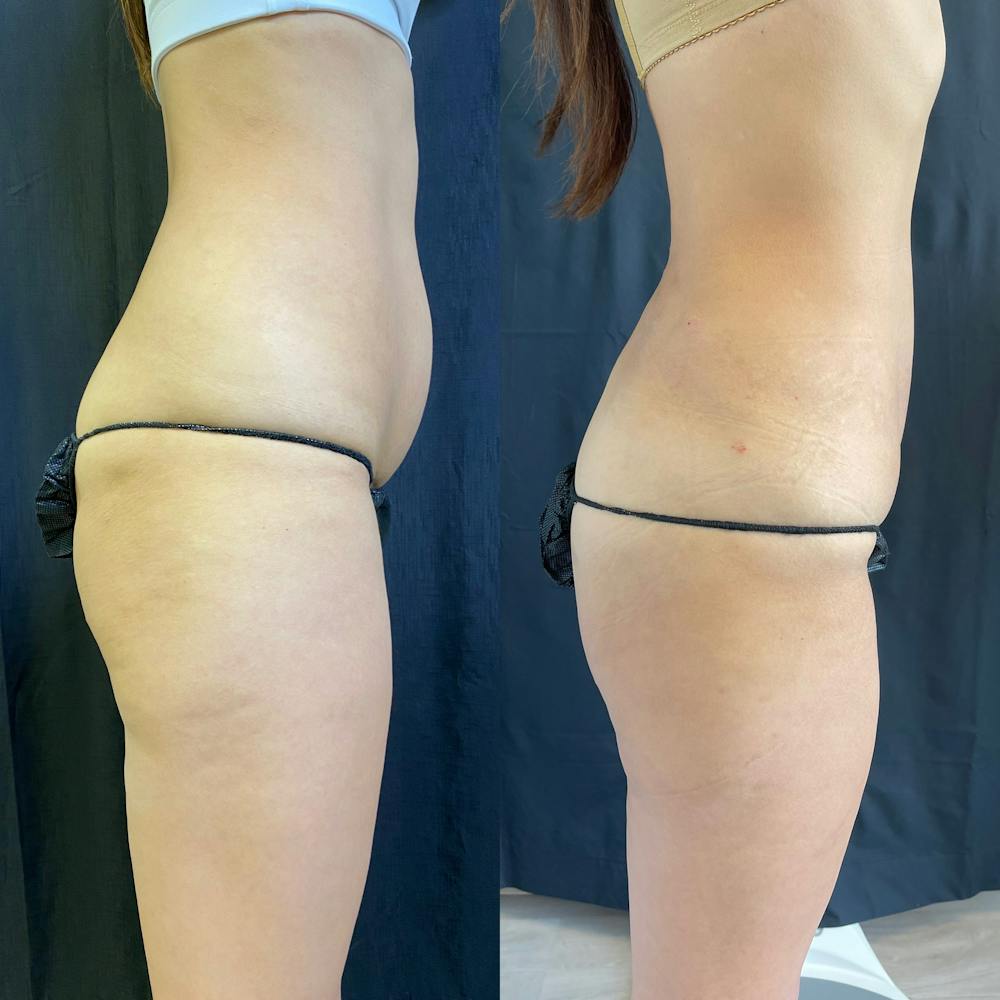 Abdomen Liposuction Before & After Gallery - Patient 146990207 - Image 2