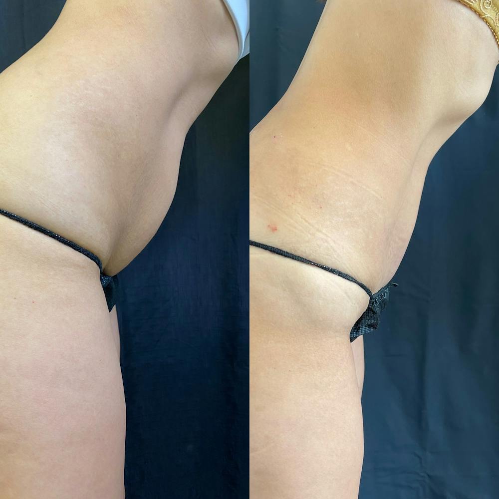 Abdomen Liposuction Before & After Gallery - Patient 146990207 - Image 4
