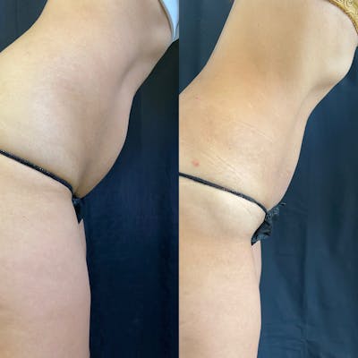 Liposuction Before & After Gallery - Patient 42746353 - Image 4