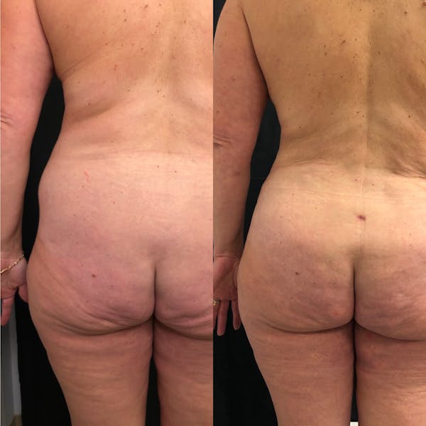 Back Liposuction Before & After Gallery - Patient 146990200 - Image 1