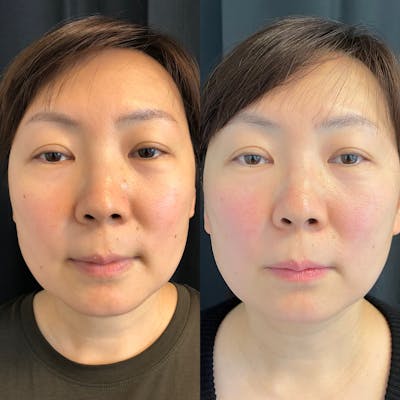 PicoWay Before & After Gallery - Patient 42746362 - Image 1