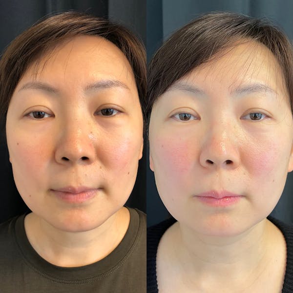 PicoWay Before & After Gallery - Patient 42746362 - Image 1