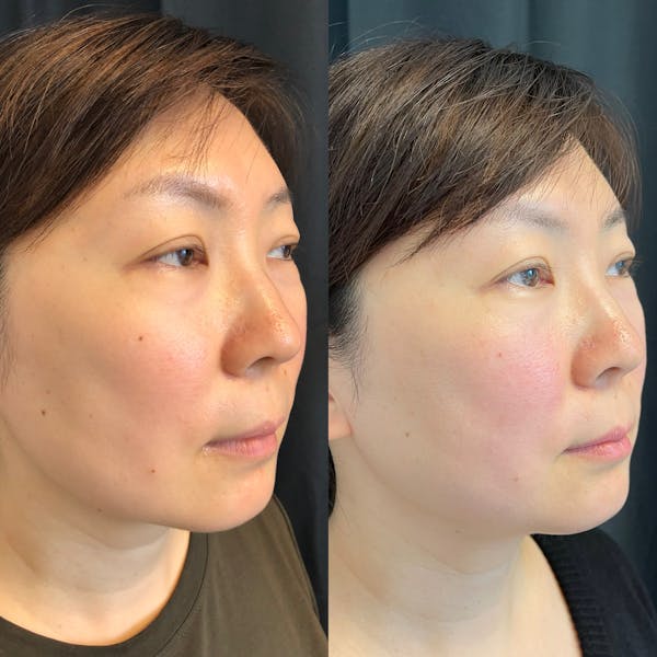 PicoWay Before & After Gallery - Patient 42746362 - Image 2
