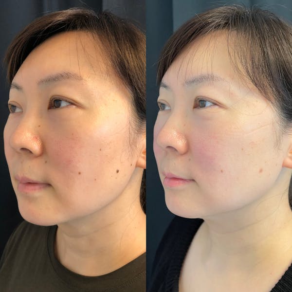 PicoWay Before & After Gallery - Patient 42746362 - Image 3