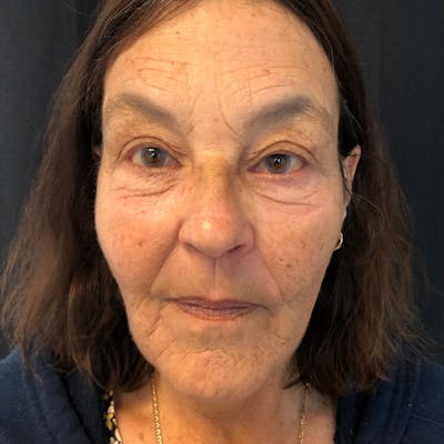 Profound Before & After Gallery - Patient 42746390 - Image 1