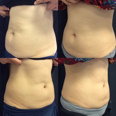 Vanquish ME Fat Reduction Before & After Gallery - Patient 42746601 - Image 1