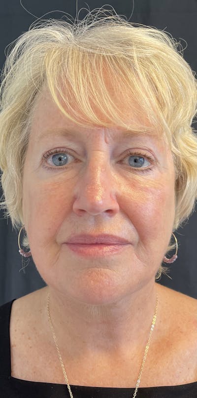 Facelift Before & After Gallery - Patient 50824372 - Image 2