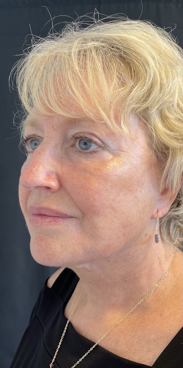 Facelift Before & After Gallery - Patient 50824372 - Image 4