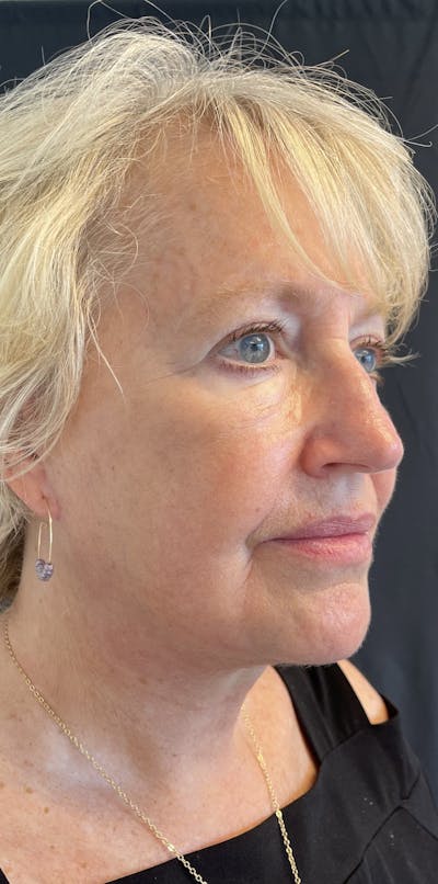 Facelift Before & After Gallery - Patient 50824372 - Image 8