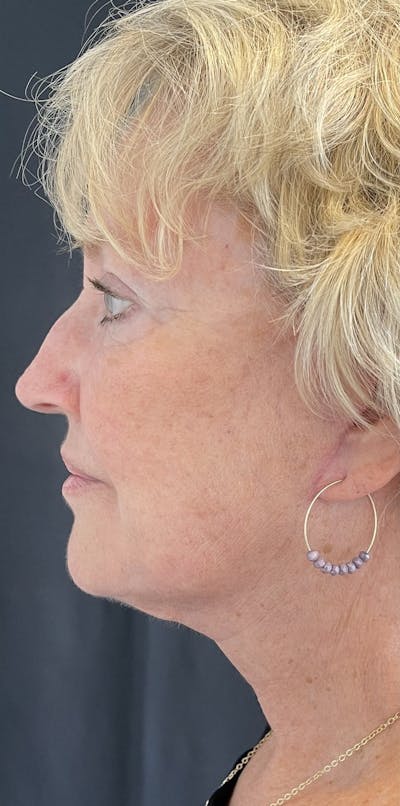 Facelift Before & After Gallery - Patient 50824372 - Image 6