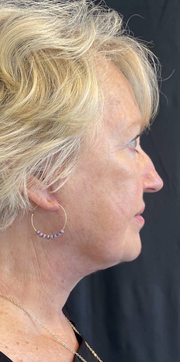 Facelift Before & After Gallery - Patient 50824372 - Image 10