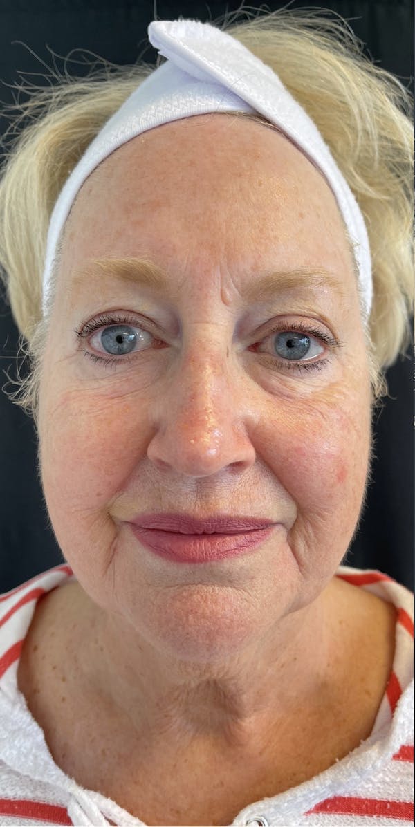 Facelift Before & After Gallery - Patient 50824372 - Image 1