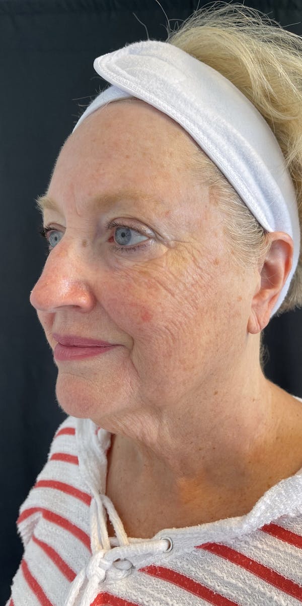 Facelift Before & After Gallery - Patient 50824372 - Image 3